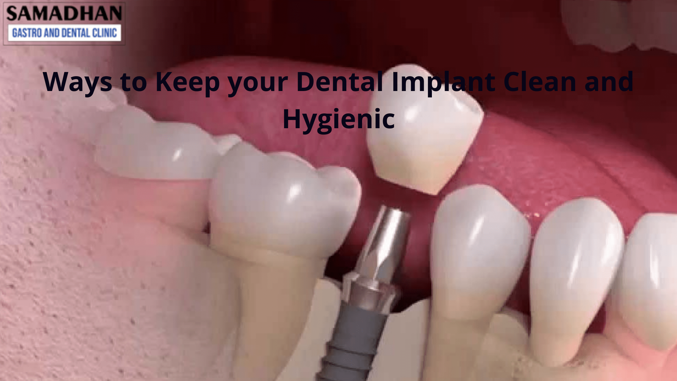 ways to keep your dental implant clean and hygienic
